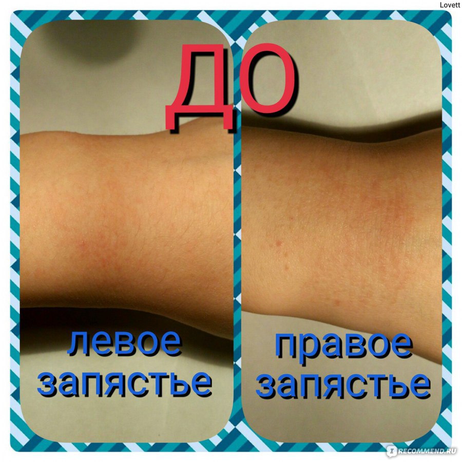 МАЙСАНА ДЛЯ НА РУРЕГОНЕГО ПРИМЕНЕЙНА